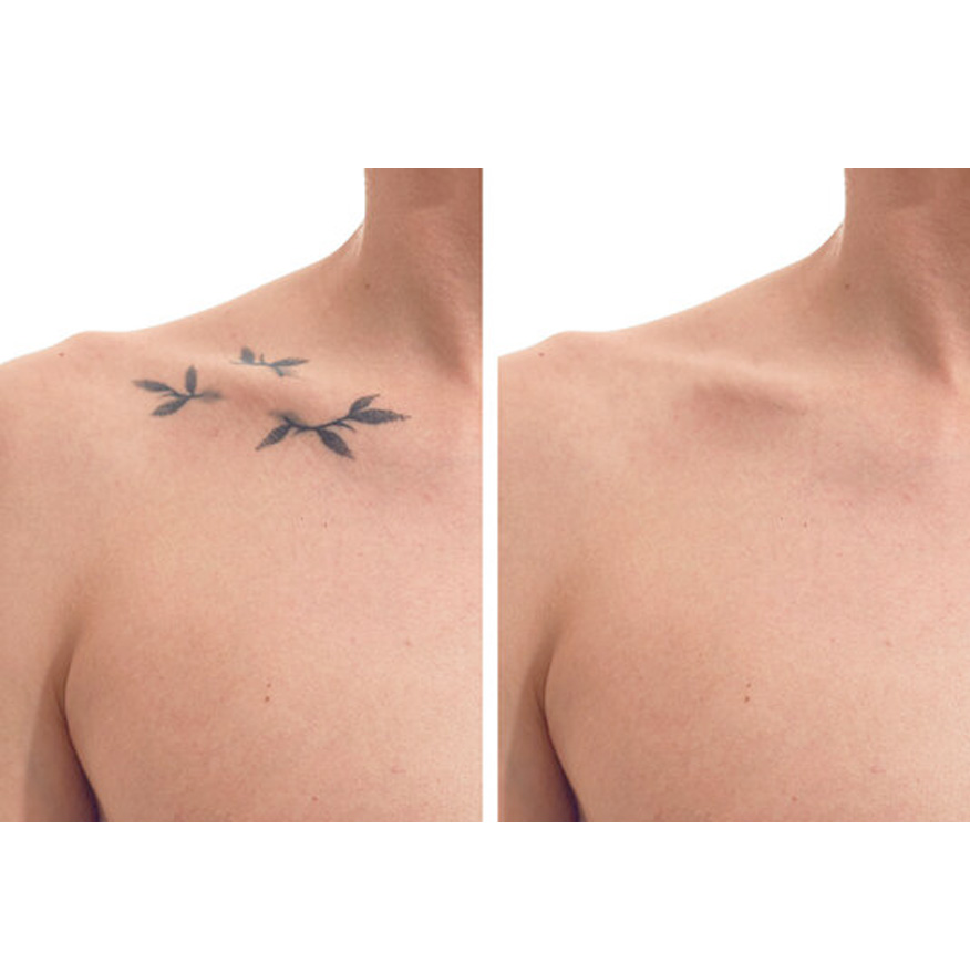 Expert Laser Tattoo Removal Services in Myrtle Beach SC Expert Laser Tattoo Removal Services in Myrtle Beach SC